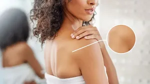 Get Clearer Skin with Dermaclear Back Acne Therapy + UA Exfoliation & Whitening at Al Dafna Medical Center