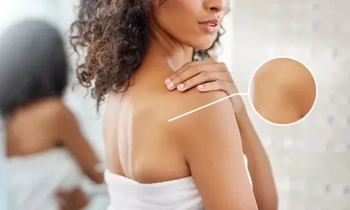 Get Clearer Skin with Dermaclear Back Acne Therapy + UA Exfoliation & Whitening at Al Dafna Medical Center