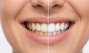 austin-medical-dealimage_health-clinic-_teeth-whitening-3__02.jpg