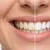 austin-medical-dealimage_health-clinic-_teeth-whitening-3__02.jpg